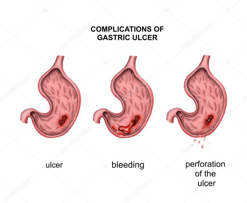 Complications of gastric ulcer. Bleeding and perforation