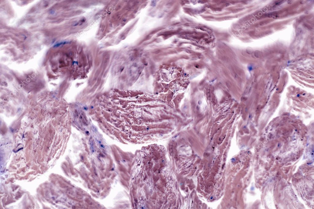 Human squamous cell carcinoma. Tissues affected by cancer cells under a microscope.