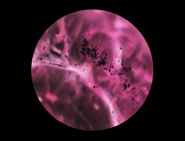 Células cancerígenas ao microscópio. Tecidos afetados por células cancerígenas — Fotografia de Stock