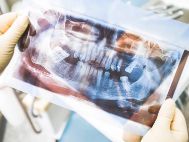dental implant tedavisi agomisis panoramik x ışını