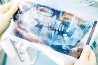 diş hekimliği staj tanı panoramik x ray