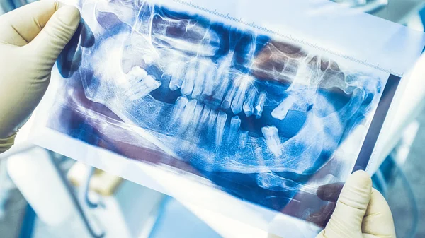 Cirurgia de implantes dentários raio-x panorâmico — Fotografia de Stock