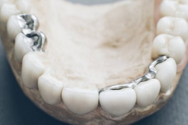 diş implantasyonu çene seramik metal protez