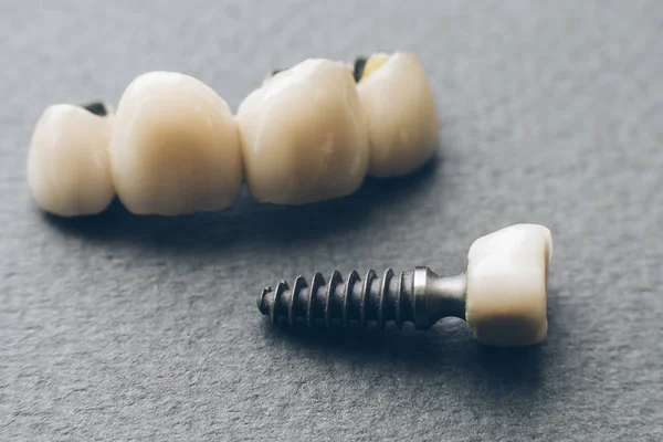 Estomatologia medicina dentária coroa dentária — Fotografia de Stock