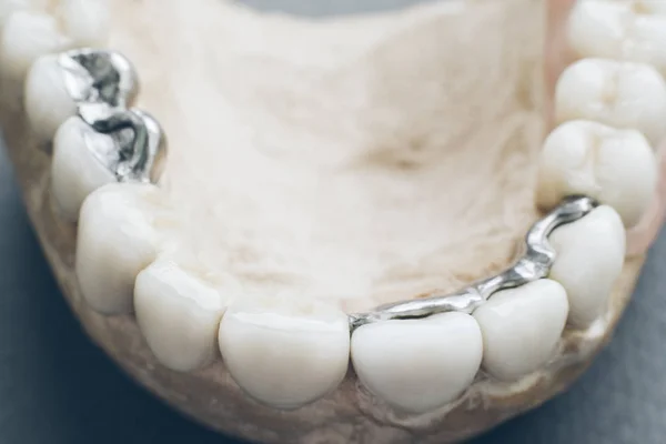 Dentiera per impianto dentale protesi in metallo ceramico — Foto Stock