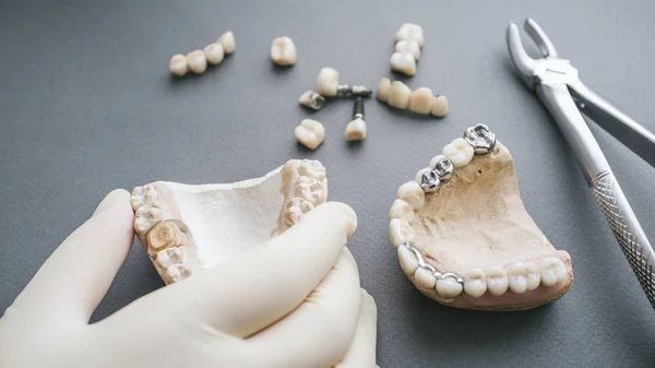 Prótesis ortodóncicas pinzas para prótesis dentales de mandíbula gitana —  Fotos de Stock