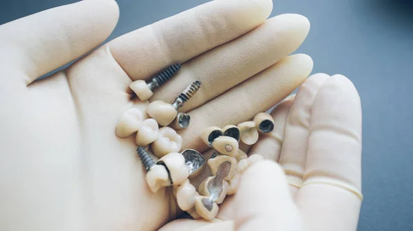 Reconstrucción dental implantes dentales de cerámica manos —  Fotos de Stock