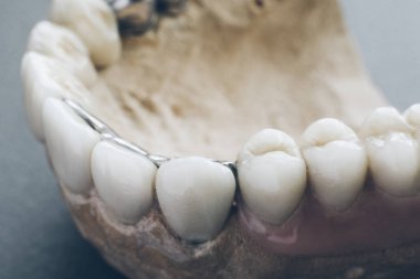 diş hekimliği implantasyon çene kalıp yapay protez