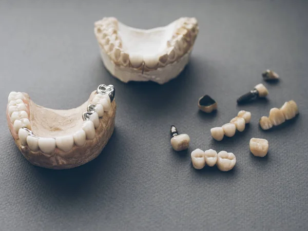 Ortodonti protez çene protezleri kron — Stok fotoğraf