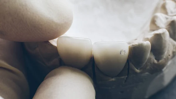 Dentes reconstrução dentista instala próteses maxilar — Fotografia de Stock