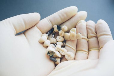 diş stomatoloji protez diş implantları