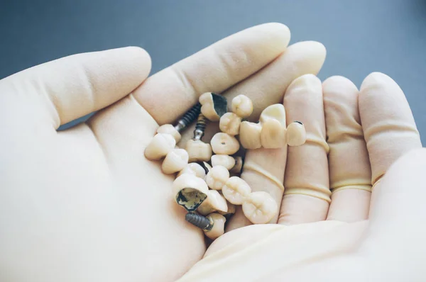 Diş stomatoloji protez diş implantları — Stok fotoğraf