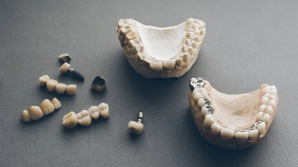 Prótesis dental mandíbulas de yeso dentaduras postizas coronas —  Fotos de Stock
