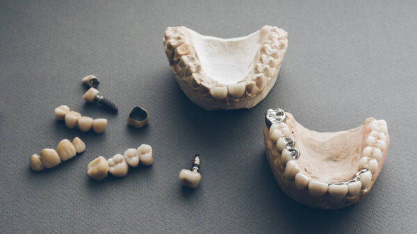 dental prosthesis gypsum jaws dentures crowns