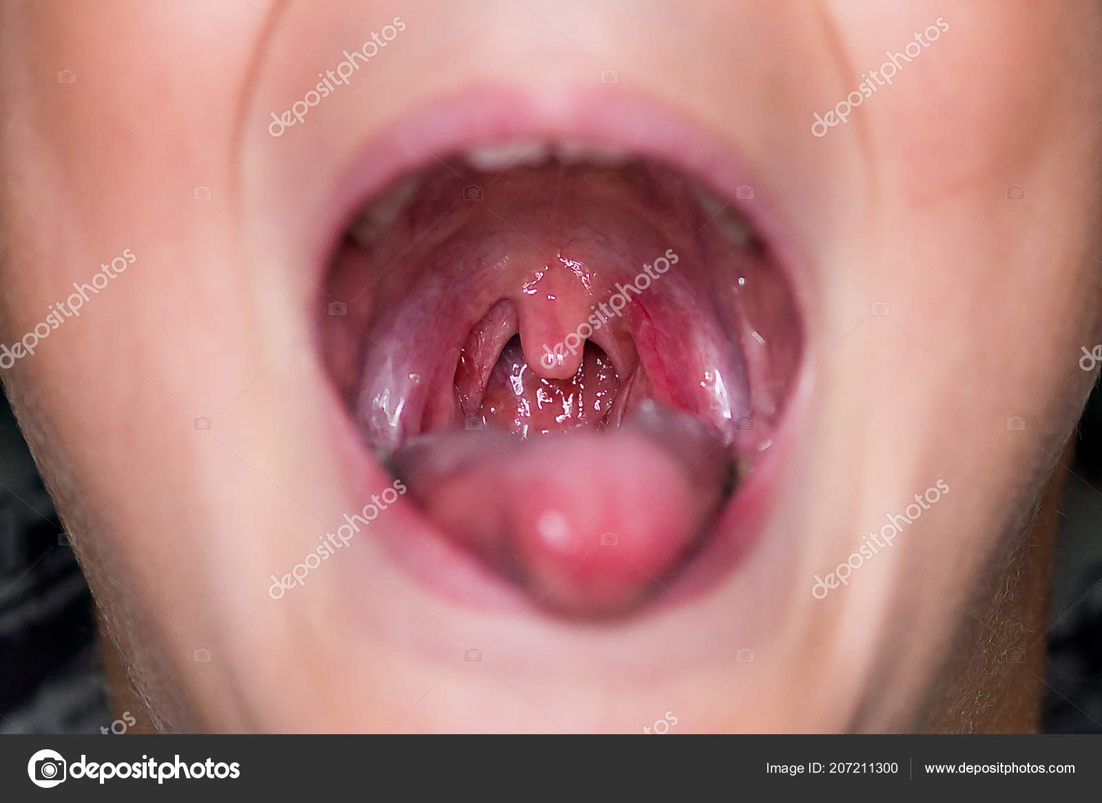 Throat Photos