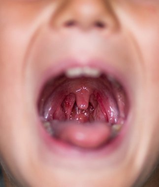 Kronik bademcik iltihabı. Herpes ile boğaz