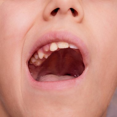 Çocuk molar diş vardır.