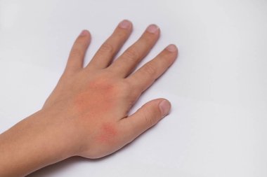 Çocuk el cilt üzerinde kırmızı lekeler nem krema ile kaplı. Kış soğuk ve Rüzgar koşulları nedenidir. Açık gri renkli.