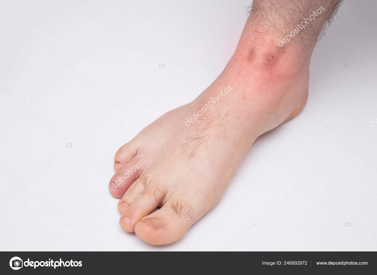 Vugge Udseende Barmhjertige Red Spots Skin Men's Feet Cause Winter Cold Wind Conditions Stock Photo by  ©Aiscream 246892972