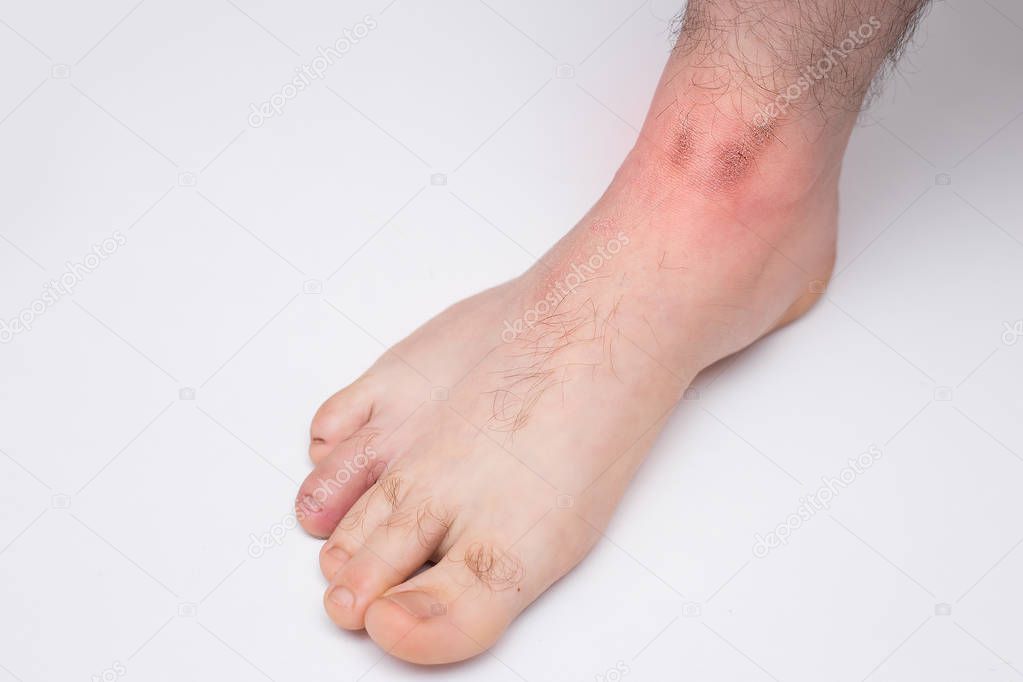 Red spots on on the skin of men's feet. The cause is winter cold and wind conditions. Light grey background
