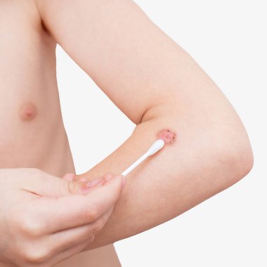 Bir pamuklu çubukla ile cilt yağlar.