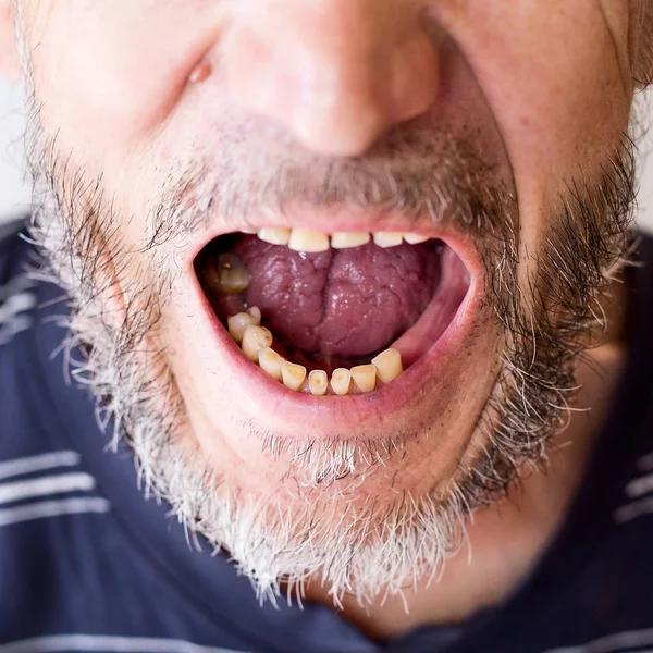 Abrasión Dientes Hombre Edad Avanzada —  Fotos de Stock