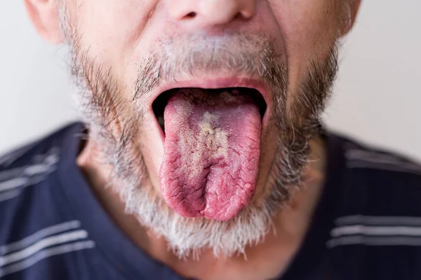 Doença Bacteriana Língua Homem Mais Velho — Fotografia de Stock