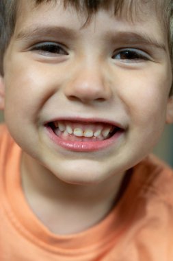 Diş hekimliği ve sağlık - çocuk hasta açık ağız çürük diş çürümesi gösteren.