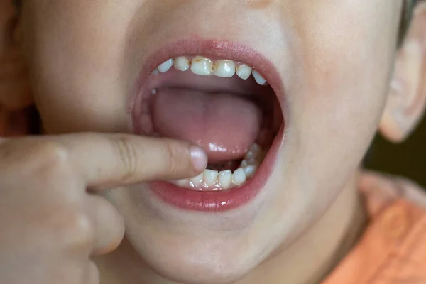 Close up photo of child dental caries. Kid open mouth showing cavities teeth decay. Unhealthy baby teeth.