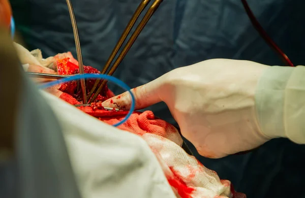 Close Das Mãos Cirurgiões Segurando Alicate Sucção Durante Trepanação Crânio — Fotografia de Stock