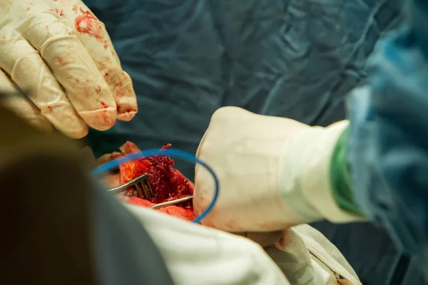 Крупный План Руки Хирурга Бинтом Зажимом Остановить Кровотечение Время Трепанации — стоковое фото
