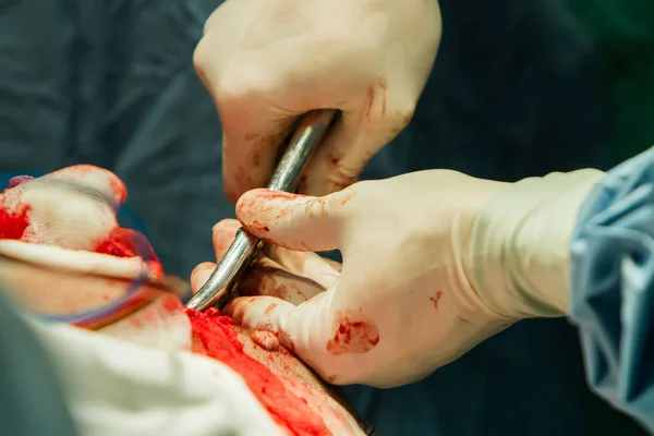 Primer Plano Mano Cirujano Con Pinzas Rompiendo Hueso Del Cráneo — Foto de Stock