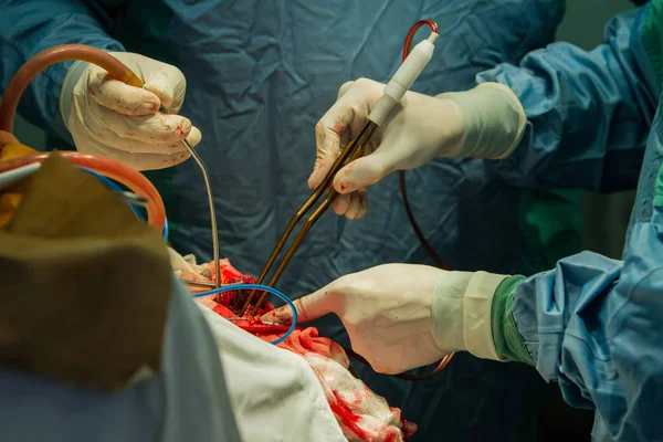 Cerrahlar Pense Emme Sırasında Kafatasının Trepanasyon Tutan Eller Close — Stok fotoğraf