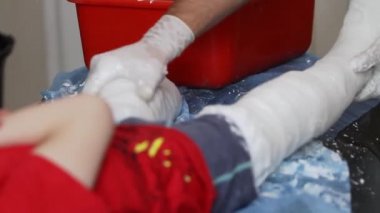 çocuğun sağ ve sol bacaklarında alçı döküm oluşturan bir doktorun ellerini yakın çekim. ses yok.
