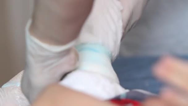 Nahaufnahme Der Hände Eines Arztes Der Einen Gips Auf Das — Stockvideo