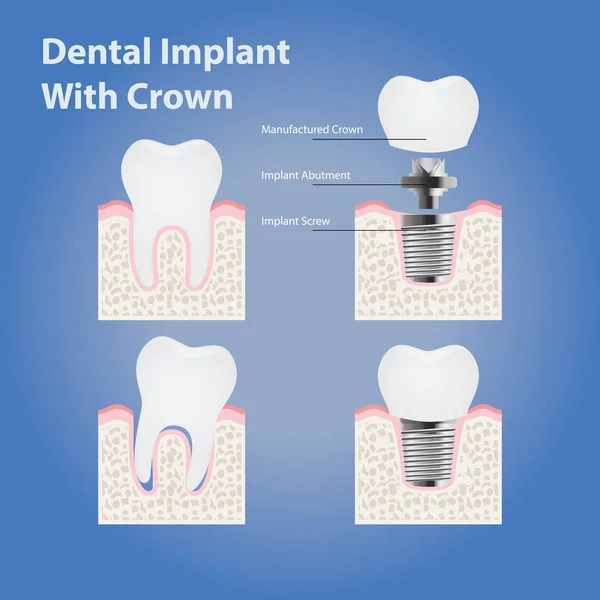 Dental Implantaat Met Kroon Gezonde Tanden Anatomie — Stockvector