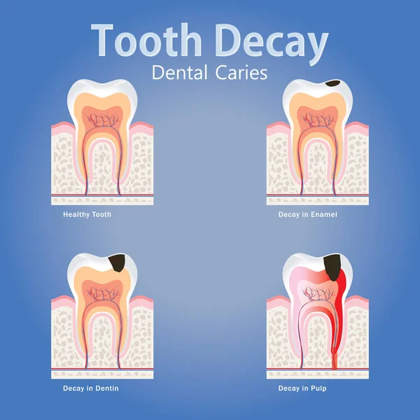 Etapas Caries Dental Concepto Anatomía Caries Dental Con Diente Sano — Archivo Imágenes Vectoriales