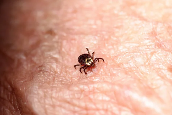 Encefalite Dos Ácaros Pele Humana — Fotografia de Stock