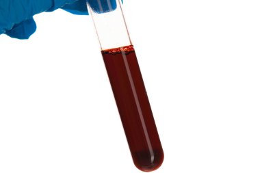 Kan tüpü testini kapat. Coronavirus 2019-ncov tanı konsepti