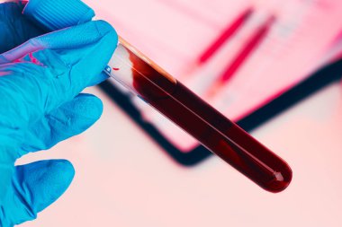 Doktorlar mavi eldiven giyer, test tüpünü kanla doldururlar.