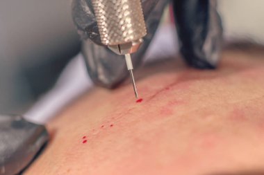 İğne kırışıklık tedavisi. İğne Mezoterapi tek iğne Clopse Up.