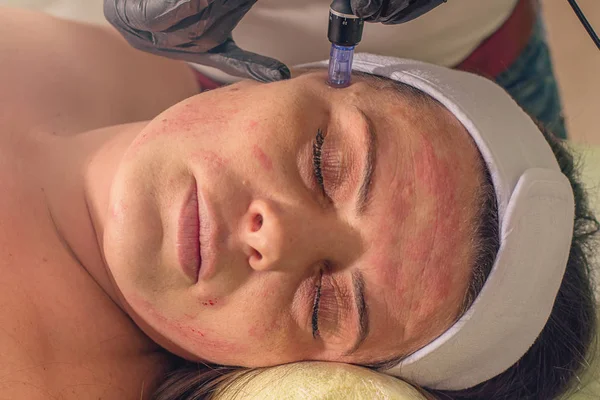 Bir kadın yüzüne iğne Mezoterapi tedavisi. 