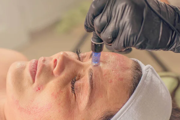 Bir kadın yüzüne iğne Mezoterapi tedavisi. 