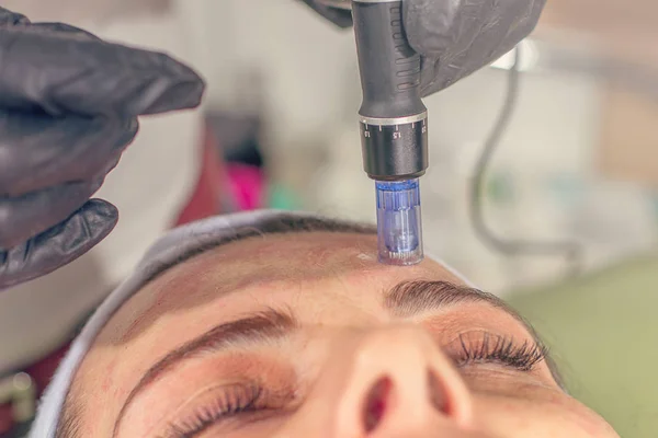 Naald Mesotherapie Behandeling Het Gezicht Van Een Vrouw — Stockfoto