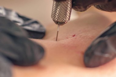 İğne kırışıklık tedavisi. İğne Mezoterapisi Tek iğne Klops