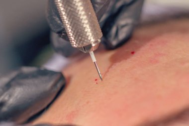 İğne kırışıklık tedavisi. İğne Mezoterapisi Tek iğne Klops