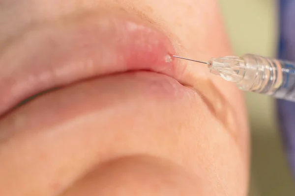 Beauty injections Close Up. Lip filler injection.
