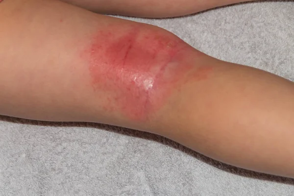 Παιδί Στο Πόδι Αλλεργία Μύκητας Νιφάδες Και Καλυμμένο Κρούστα Θεραπεία — Φωτογραφία Αρχείου
