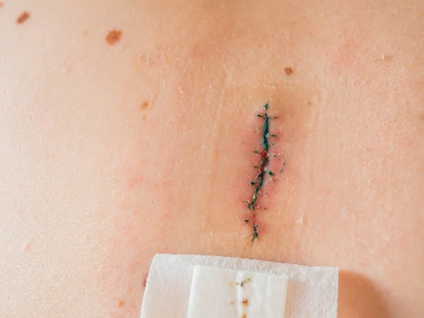 Close Photo Scar Removal Surgical Sutures Large Nevus Has Been — Stock Photo, Image