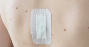 Kürek kemikleri arasında alçı. Cerrahi sütür çıkarıldıktan sonra yara izi. Büyük nevus neşterle cerrahi olarak eksize. Cilt kanserine karşı önlem.